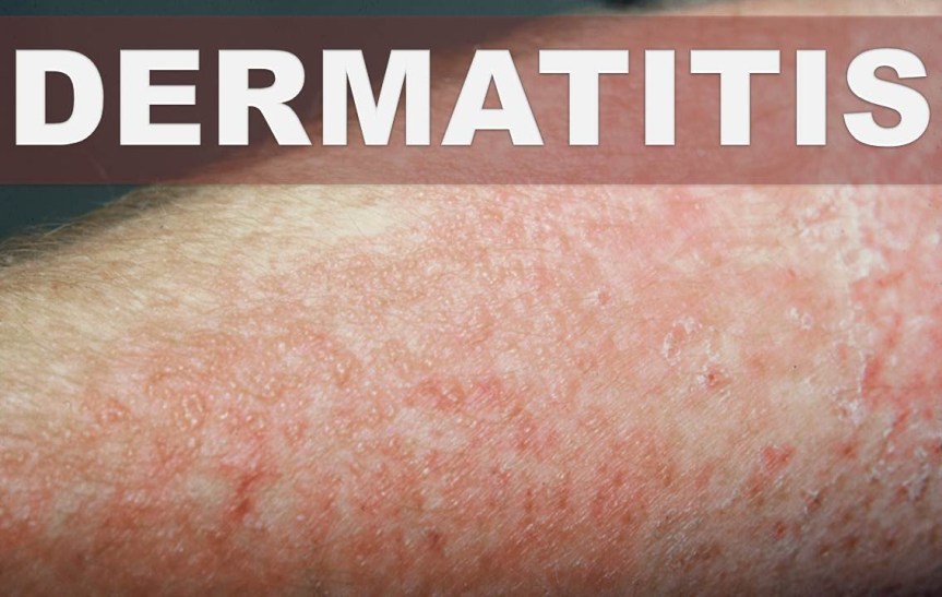 Eczema – Dermatitis