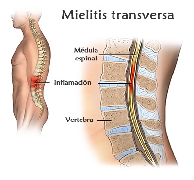 Mielitis transversa aguda