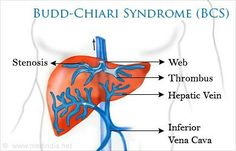 Venas abdominales dilatadas por síndrome de Budd-Chiari y obstrucción de vena&nbsp;cava