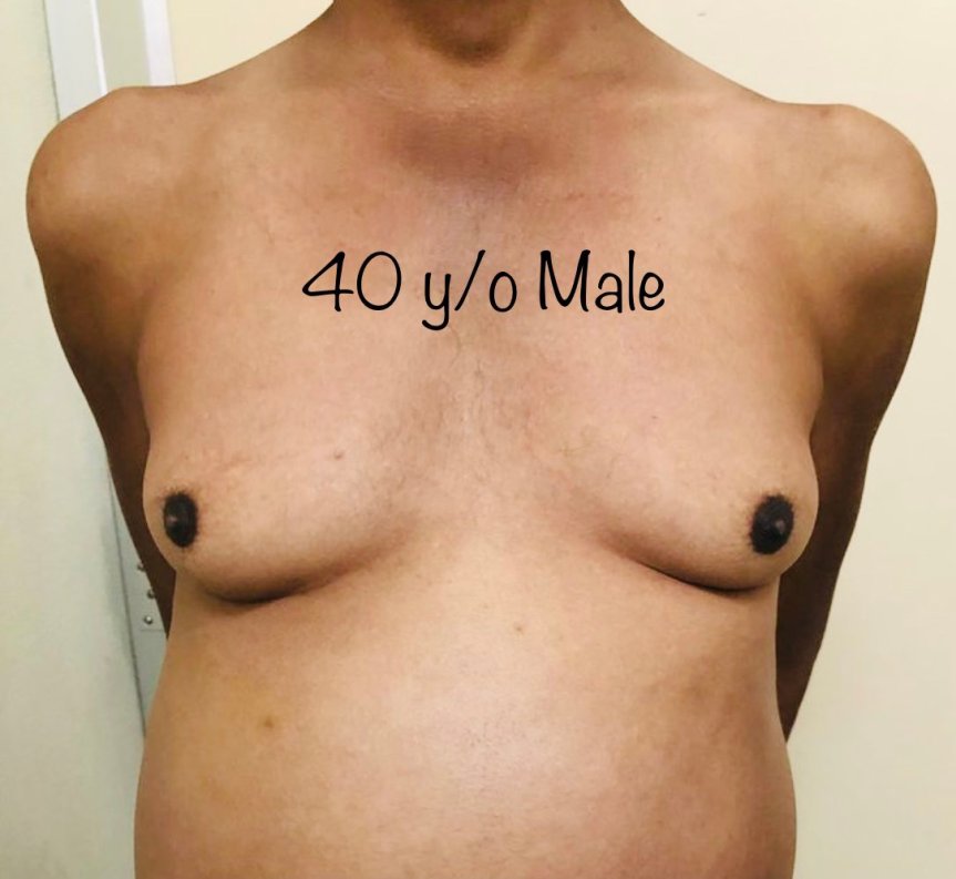 Paciente masculino que recibe múltiples antihipertensivos