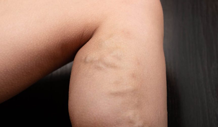 ❓ Doctor, ¿la insuficiencia venosa tiene cura?&nbsp;#DoctorPorQué